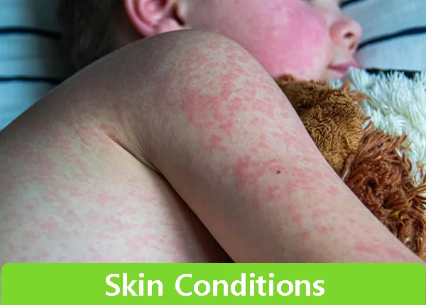 Skin Conditions